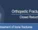 Closed Reduction of a Fractured Bone | Orthopedic Fracture Car NASA MRI