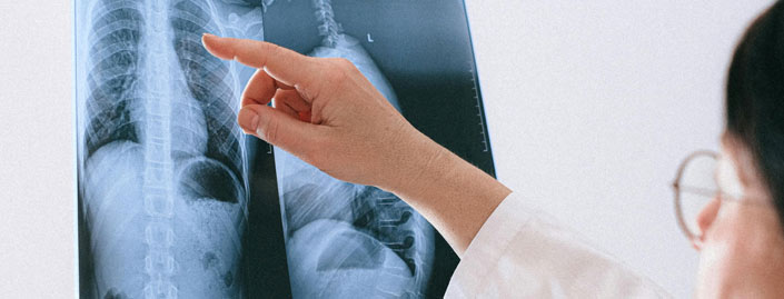 Doctor inspecting an x-ray to determine if back surgery is needed | NASAMRI Naples Florida